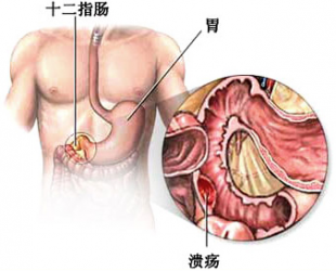 十二指肠球部溃疡的治疗